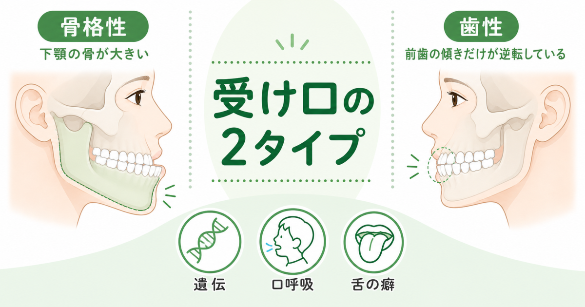 ■受け口(反対咬合)とは?原因に遺伝はどこまで関係する?